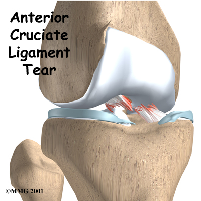 ACL Tears: Can we Prevent Them?